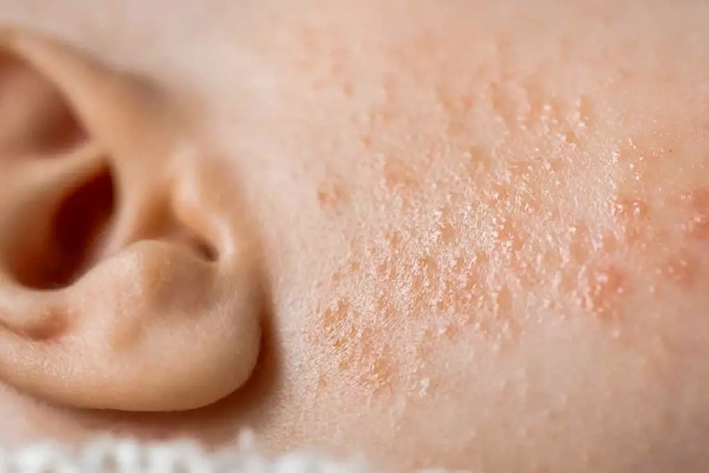 Other Ways to Treat Baby Acne