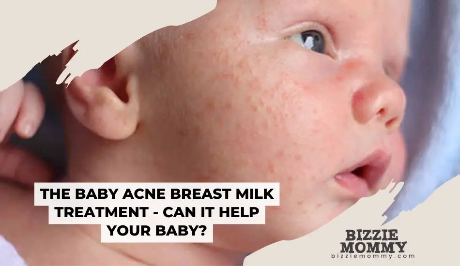 baby acne breast milk